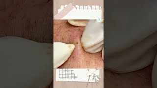 Big Cystic Acne Blackheads Extraction Blackheads amp Milia Whiteheads Removal Pimple Popping shorts [upl. by Roana]