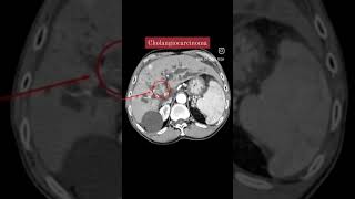 Cholangiocarcinoma CT Abdomen shorts shortsvideo viral [upl. by Nimajneb]