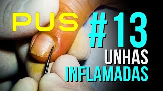 NOVA TEMPORADA SÉRIE 13 UNHAS INFLAMADAS INFLAMED NAILS NEW SEASON  13  PODÓLOGO MAURÉLIO [upl. by Eidur]