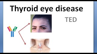 Ophthalmology 423 Thyroid Eye Disease Graves Exophthalmos Proptosis NOSPECS Classification Cause [upl. by Enilrek]