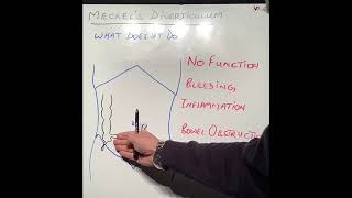 S1E32 Meckel’s Diverticulum [upl. by Roze]