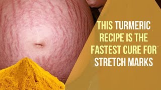 This Turmeric Recipe is the Fastest Cure for Stretch Marks [upl. by Fontana]