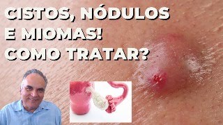 Cistos nódulos e miomas como resolver [upl. by Zelig]