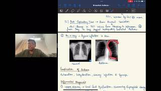 BRONCHIAL ASTHMA For University Studentsl Dr Sahil Bansal [upl. by Marolda]