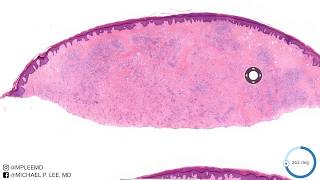 Erythema Elevatnum Diutnem Rare form of vasculitis Dermpath Made Easy [upl. by Desdee844]