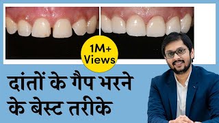 दाँतो के बीच की गैप को कैसे ठीक करें  CloseFill Gap In Teeth  Seraphic Dental Indore  Dr Ankit [upl. by Yule]