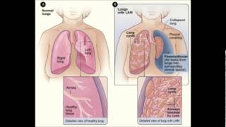 Lymphatic system diseases [upl. by Conyers]