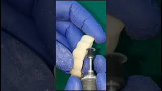 Shapping and giving incisal Embrasure for CADCAM milled G  CAM  Bridge [upl. by Riorsson478]