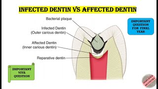 Infected Dentin Vs Affected Dentin [upl. by Jacoba]