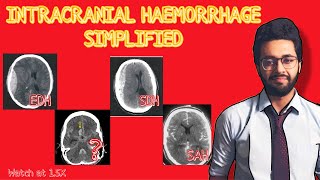 Intracranial Haemorrhage Simplified  ExtraduralSubdural and Subarachnoid Haemorrhage explained [upl. by Slen125]