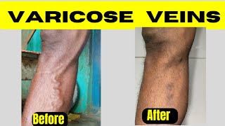 Varicose veins treatment before SSC GD [upl. by Minier]