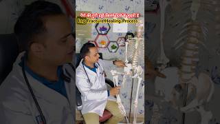 Leg Bones Fracture Healing Process trending viralvideo [upl. by Morehouse]