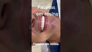 Facetas em resina composta [upl. by Adriane]