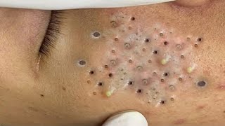 Blackheads amp Whiteheads Satisfying Removal 0284 [upl. by Cornie283]