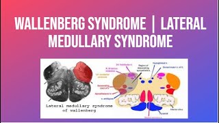 Wallenberg Syndrome  Lateral Medullary Syndrome  PhysiotherapyKnowledge [upl. by Om53]