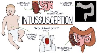 Understanding Intussusception [upl. by Fachanan]