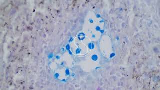 Cryptococcus neoformans under the microscope with Alcian Blue and PAS Stain [upl. by Akcirret]