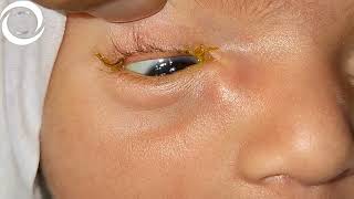 Congenital Lacrimal Encysted Mucocele [upl. by Ak]