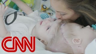 Rare surgery to separate conjoined twins [upl. by Yelreveb4]