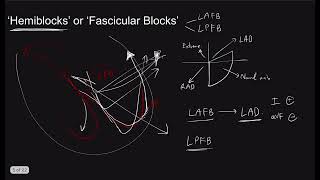 Bundle Branch Block the Series Part 2 AdvancedHemiBifascicular blocks I The Pacemaker [upl. by Levison]