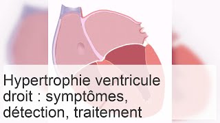 Causes et diagnostic de lhypertrophie du ventricule droit [upl. by Euphemiah448]