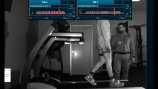 Quadriceps Avoidance Walking Gait Analysis [upl. by Anazraf904]