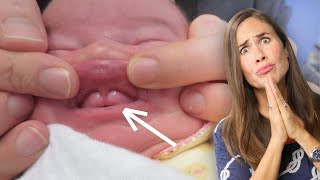 Lip Tie How to Check Your Baby And How to Fix it [upl. by Staford399]