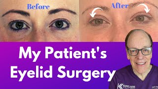 My Patients Blepharoplasty  Eyelid Surgery Journey [upl. by Acinomal]