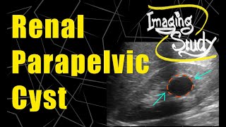 Renal Parapelvic Cyst  Bosniak GradeI  Ultrasound  Case 83 [upl. by Lefkowitz]