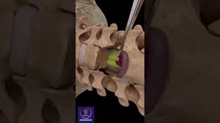 Anterior Cervical Discectomy amp Fusion shorts [upl. by Remark870]