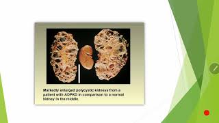 cystic kidney disease [upl. by Ahsotal31]