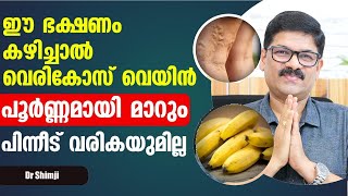 ഈ ഭക്ഷണങ്ങൾ കഴിച്ചു വെരികോസ് വെയ്ൻ പൂർണമായി മാറ്റം Vericose Treatment in Malayalam  Dr Shimji [upl. by Yrtsed]