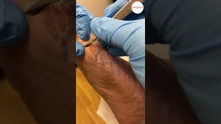 Pinch callus removal with scalpel [upl. by Barthol]