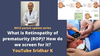 Retinopathy of prematurity in preterm babies Why do we screen for ROP how to treat Dr Sridhar K [upl. by Suiluj]