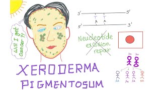 Xeroderma Pigmentosum [upl. by Anivek]