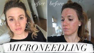 MY FIRST MICRONEEDLING EXPERIENCE amp WHAT TO EXPECT ACNE SCAR TREATMENT [upl. by Bartko]