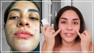 PRIMER MES CON TRATAMIENTO ANTI ACNÉ Con Epiduo Gel  Gabcamva [upl. by Naraa985]