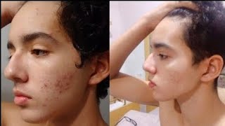 Los consejos que segui para curar mi acne [upl. by Yehus]