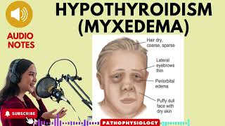 Hypothyroidism Myxedema Causes SignsSymptoms amp treatment [upl. by Rasec]