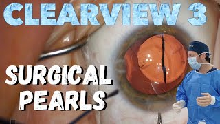 Cataract Surgery Pearls with the Clearview 3 Lens Implant [upl. by Volny73]