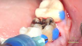 Tooth autotransplantation  Autotransplante Dental 36 [upl. by Tenneb]