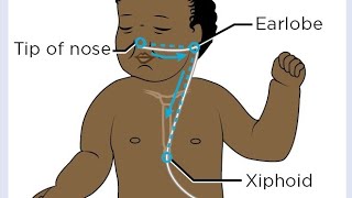 how to insert OG tube Orogastric tube in newborn baby cutebaby newbornbaby hospital nicubaby [upl. by Colette]