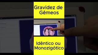 Gravidez de Gêmeos Idêntico ou Monozigótico shorts shortvideo [upl. by Yauqaj]