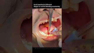 tongue tie surgery videoankyloglosiatongue surgery for speech therapy video [upl. by Olson612]