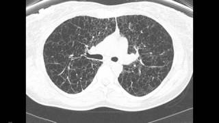 HighResultion CT of the Chest CaseReview Webinar [upl. by Kcirdor]