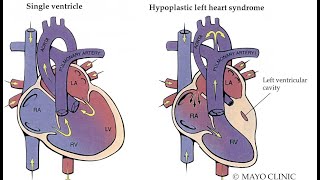 Hypoplastic left heart syndrome HLHS causes symptoms amp pathology [upl. by Artnoed]