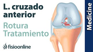 Rotura de ligamento cruzado anterior  Diagnóstico tratamiento de fisioterapia médico y quirúrgico [upl. by Seiter]