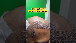 hair transplant hair hairloss besthairtransplant drpranilmore ytshorts shorts highdensity [upl. by Ettedo801]