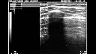 Normal lung vs pneumothorax [upl. by Asylla]