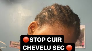 COMMENT LUTTER CONTRE LE CUIR CHEVELU SEC  ACTIFS ASTUCES [upl. by Anitsrhc]